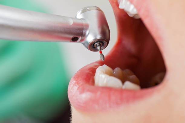 Best Emergency Dental Care for Broken or Chipped Teeth in Gages Lake, IL